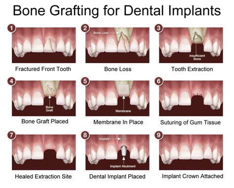 bone traducción|bone grafting in spanish.